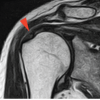 Loose Body Formation in the Subacromial Bursa following Rotator Cuff Repair with a REGENETEN® Bioinductive Implant: A Case Report