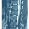 Adolescent Cauda Equina Secondary to Traumatic Lumbar Disc Herniation: A Rare Case Report with Review of Literature