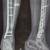 Clinical and Functional Outcome of Distal Tibial Fractures Treated with Minimally Invasive Percutaneous Plate Osteosynthesis Technique using Anatomical Distal Tibial Plate: A Case Series