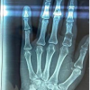 Enchondroma of Hands: A Surgical Dilemma and Our Experience