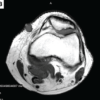 Extradigital Glomus Tumor of the Knee Mimicking Osteoarthritis: A Case Report