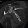 Multifocal Osteonecrosis in the Hips and Shoulders Bilaterally after Severe COVID-19 Infection Misdiagnosed as Fibromyalgia: A Case Report