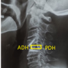 Anterior Cervical Discectomy and Fusion with Polyetheretherketone Cage or Anterior Cervical Plate: A Comparative Evaluation of Short-term Outcomes