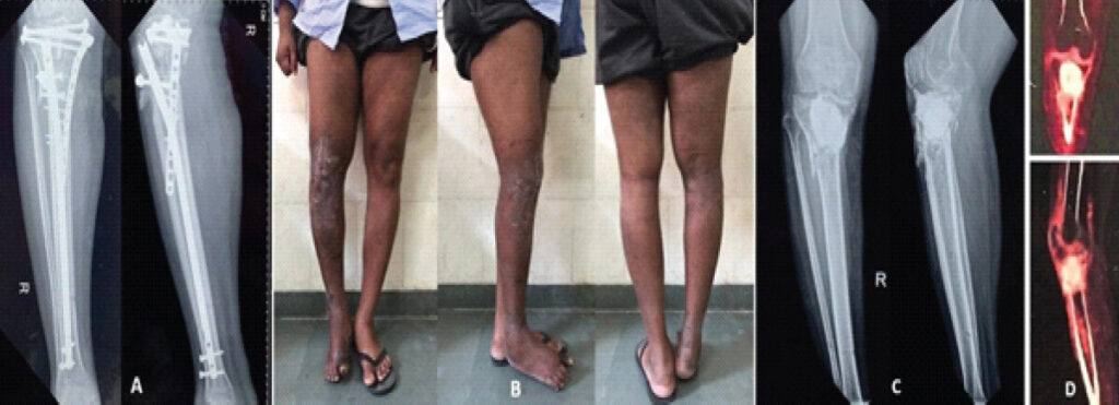 Figure 1: (a) Initial anteroposterior (AP) and lateral (Lat) radiographs of the patient, showing a maluniting proximal tibia fracture with implants in situ; (b) Clinical pictures of the patient at initial presentation; (c) AP and Lat radiographs of the patient at presentation to our centre, showing a varus malunion of the proximal tibia with a large cement spacer in situ. Anterior cortical deficiency can be appreciated by extravasation of cement in the anterior part of the tibial plateau; (d) 18-flourodeoxyglucose positron emission tomography images showing tracer concentration in the proximal tibia, joint space, and parts of the medullary cavity.