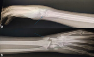 Figure 1: Pre-reduction radiographs (a and b). (a) Anteroposterior pre-reduction radiograph showing displaced scaphoid waist fracture with associated volar lunate dislocation. (blue arrow pointing to styloid radius fracture), (b) lateral pre-reduction radiograph demonstrating radial styloid fracture and perilunate dislocation pattern (blue arrow pointing to lunate volar).