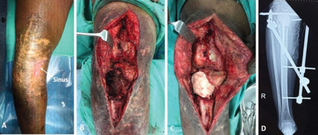 Figure 2: (a) Adherent skin with sinus tract; (b) large cavitary defect of proximal tibia uncovered after satisfactory debridement, with intact articular surface; (c) void filled with antibiotic-laden cement spacer; (d) immediate post-operative radiograph showing stemmed cement spacer with temporary external fixation in situ.