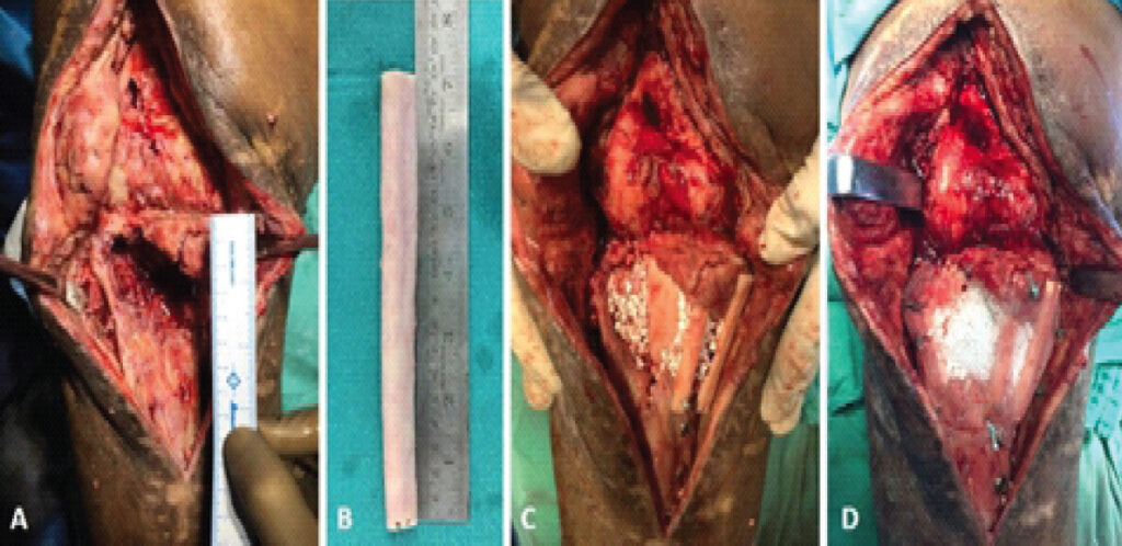Figure 4: (a) Second stage of surgical procedure following debridement, a cavitary defect measuring 6 × 8 cm was present; (b) Ipsilateral fibular graft measuring 18 cm in length; (c) Bone grafting of cavity using the bell-tent method, with a central fibular pole and three short-guy fibular struts, void filled up with a mix of cancellous and synthetic bone graft in the ratio 3:1; (d) Polypropylene mesh applied to secure the graft and substitute the deficient anterior wall.