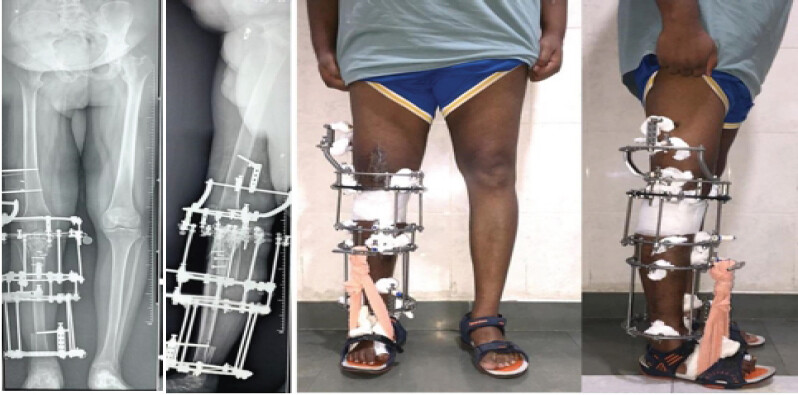 Figure 5: Long leg films and clinical pictures, showing a restoration of normal limb alignment.