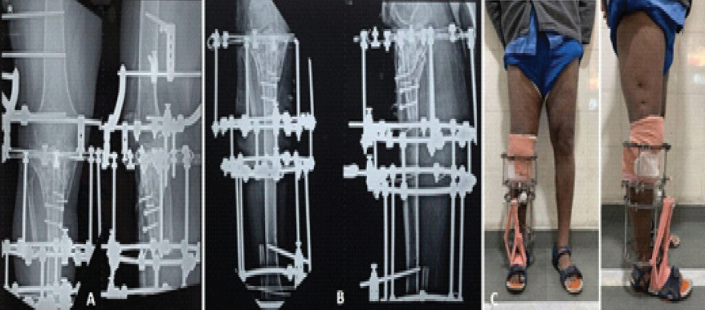 Figure 6: (a) Anteroposterior and lateral radiographs of the knee joint demonstrating the radiolucent carbon-fiber ring over the joint and position of subchondral “raft” wires; (b) radiographs following removal of the knee-spanning portion of the frame; (c) clinical images following removal of the knee-spanning portion of the frame.