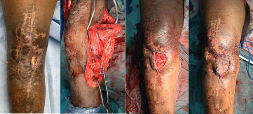 Figure 7: Skin breakdown over anteromedial tibia, exposing underlying bone; medial gastrocnemius flap done after excising redundant skin and mesh to provide adequate soft-tissue cover.