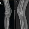Iatrogenic Fibula Head Avulsion Fracture in Fixed Valgus Arthritic Knee During Total Knee Arthroplasty