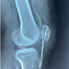 Neglected Ruptures of the Patellar Tendon: Report of Three Cases in the Orthopedic Trauma Department of Dalal Jamm Hospital, Dakar