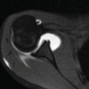 Rare Presentation of Chronic Anterior Instability with Concomitant Triad of Anterior Labral Periosteal Sleeve Avulsion, Hill–Sachs, and Humeral Avulsion of the Glenohumeral Ligament Lesions: A Case Report