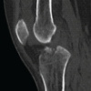 Simultaneous Anterior Cruciate Ligament Avulsion Fracture with Bilateral Posterior Meniscal Root Tears of the Knee: A Case Report