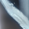 A Case Series on Management of Neglected Monteggia Fractures