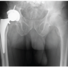 Lateral Femoral Cutaneous Nerve Neuroma Resection and Nerve Capping after Direct Anterior Approach: A Case Report