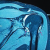 Understanding Synovial Chondromatosis: A Rare Cause of Shoulder Impingement