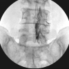 Effectiveness of Epidural Methylprednisolone Injection in Management of Lumbar Prolapsed Intervertebral Disc: A Comparison of Caudal, Transforaminal and Interlaminar Routes