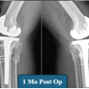 Traumaplasty in Action: Staggered Bilateral Primary Total Knee Arthroplasty for Complex Proximal Tibial Fractures with Osteoarthritis – A Case Report