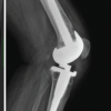 Interest of a V-Y Quadricepsplasty in Bilateral Total Knee Arthroplasty for Ankylosed Flexion Knees in a Patient with Rheumatoid Arthritis – A Case Report