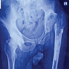 Acute Prosthetic Joint Infection of Revision Total Hip Arthroplasty Managed with Debridement, Antibiotics, Implant Retention, and Flap Coverage: A Case Report