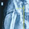 Proximal Femur Stabilization Using Prolene Mesh in Girdlestone Resection Arthroplasty: A Case Report