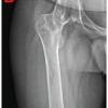 Wheelchair to Walking: Quadruple Arthroplasty of Hip and Knee Joints in a Patient with Severe Ankylosing Spondylitis