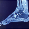 Aneurysmal Bone Cyst of Lateral Cuneiform: Challenge in Diagnosis and Management