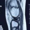 Functional and Radiological Outcome of Arthroscopic Meniscal Repair for Discoid Meniscus