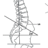 Correlation between Radiographic Parameters and Lordosis in Patients with Chronic Low Back Pain