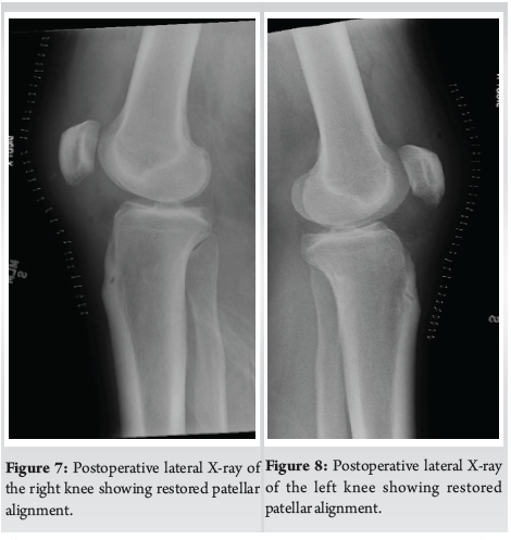 Simultaneous Bilateral Patellar Tendon Ruptures Treated with Primary ...