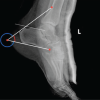 A Prospective Case Series: Functional Outcomes after Calcaneal Tuberosity Partial Resection for Haglund’s Syndrome