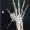 Chondromyxoid Fibroma of the Right Thumb: Successful Management with Wide Local Excision, Iliac Crest Bone Grafting and K-Wiring – A Rare Case Report