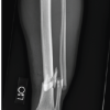Open Reduction and Treatment with Bone Morphogenetic Protein-2 for Correction of Closed Tibial Pseudoarthrosis in a 32-Year-Old Non-smoking Male with Osteoporosis and Hypogonadism: A Case Report