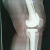 Complex Two-Stage Revision Total Knee Arthroplasty with Intramedullary Infection Management Using Elastic Titanium Pin Spacer Technique in a Morbidly Obese Patient: A Case Report