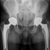 Recurrent Ceramic Femoral Head Fracture in Dual Mobility Total Hip Arthroplasty: A Case Report
