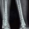 Functional Outcome of Distal Third Tibial Fractures Treated by Posterior versus Medial Plating – A Prospective Comparative Study