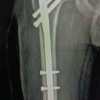 Clinical Effects of Working Length of Cephalomedullary Nails in Pertrochanteric Femur Fractures: A Case Series of 30 Patients