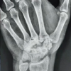 Recurrent Giant Cell Tumor of the Carpal Bones in an Adult Male Managed by En-bloc Excision, Extended Curettage, Bone Grafting, and all-Kirschner Wire Fixation: A Rare Case Report and Literature Review