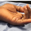 “Spiderman Sign:” A Case Report of Ipsilateral Index and Little Finger Flexor Tendon Injury