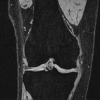 MRI–Histopathology Correlation of Cartilage and Bone in Early Knee Osteoarthritis