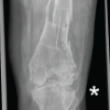 Case Report of Post-Traumatic Monoarticular Tuberculosis of the Knee in a Healthy Young Adult: Diagnostic and Therapeutic Challenges in a Non-Endemic Setting