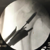 Retrieval of a Sunken Interference Screw during Core Decompression and Autologous Adult Live-cultured Osteoblast Injection for Bilateral Hip Avascular Necrosis: A Case Report