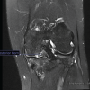Artelon Graft Augmentation in Revision Anterior Cruciate Ligament Reconstruction: Surgical Technique Guide