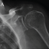 Ten-year Survivorship after Anterior Latissimus Dorsi Transfer for Irreparable Subscapularis, Followed by Conversion to Reverse Total Shoulder Arthroplasty: A Case Report