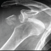 Performance of ChatGPT‑5 in Diagnosing Fractures on Proximal Humerus and Intertrochanteric Femur X-Rays