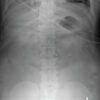 Degloving in Disguise: Managing a Delayed Spinal Morel-Lavallée Lesion after Thoracic Fracture-Dislocation