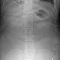 Figure 1: Initial anteroposterior radiograph of the thoracic and lumbar spine. Demonstrates moderate degenerative joint disease.