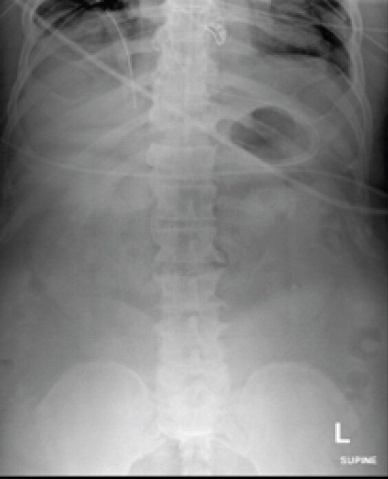 Figure 1: Initial anteroposterior radiograph of the thoracic and lumbar spine. Demonstrates moderate degenerative joint disease.