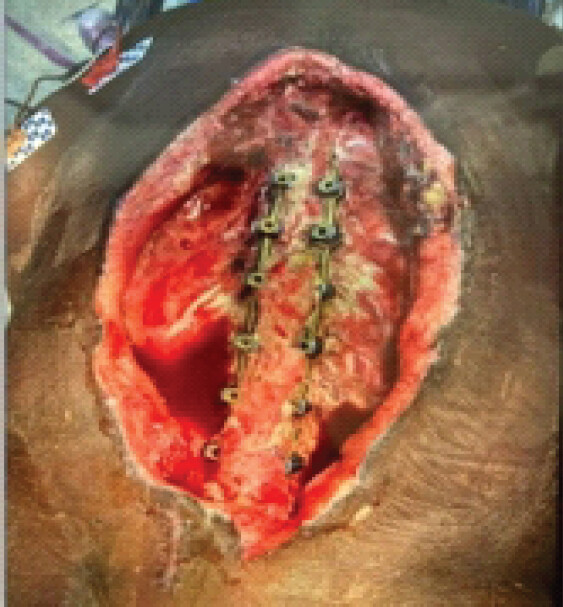 Figure 10: Intra-operative wound clinical photographs on admission day 65.